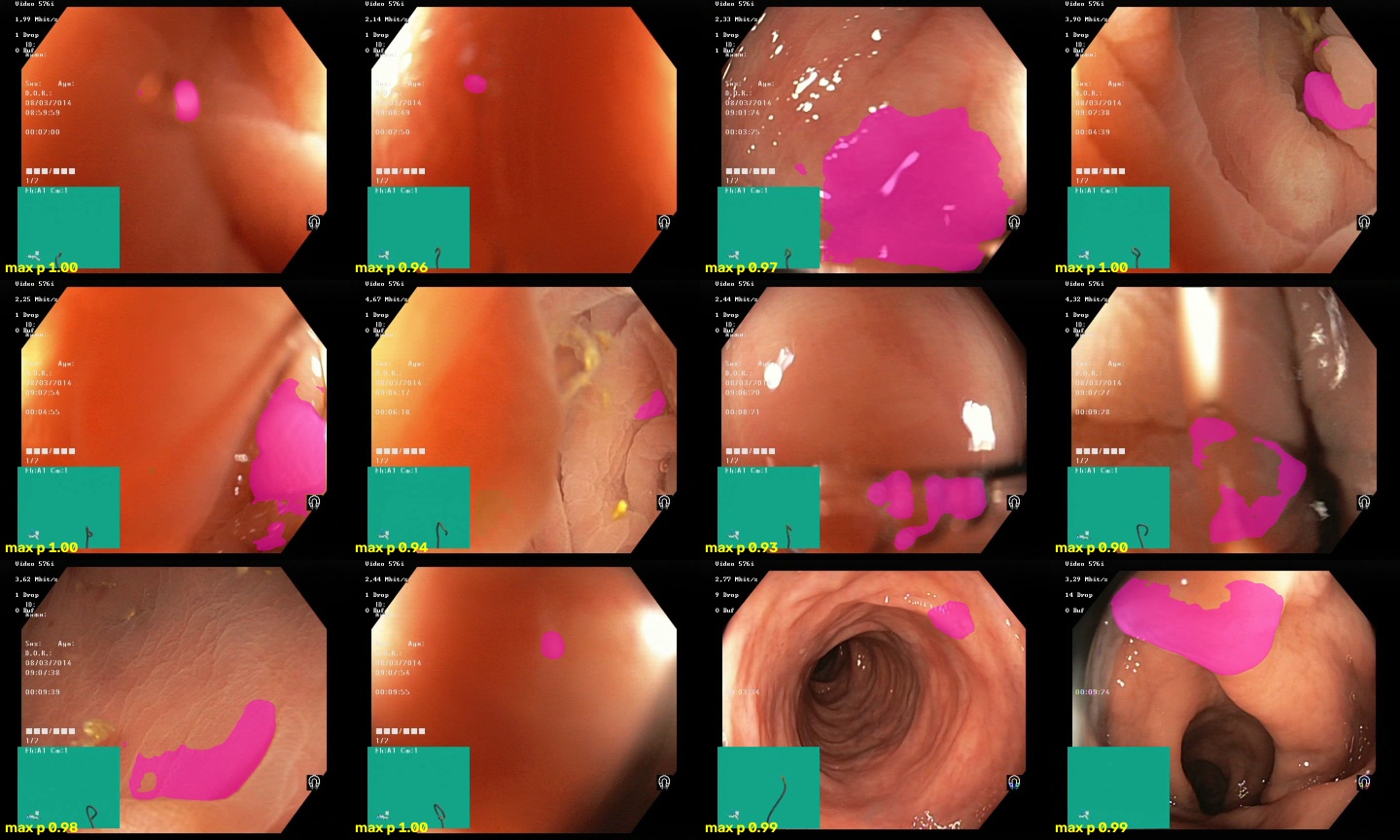 False positives of the positives-only model on normal colon